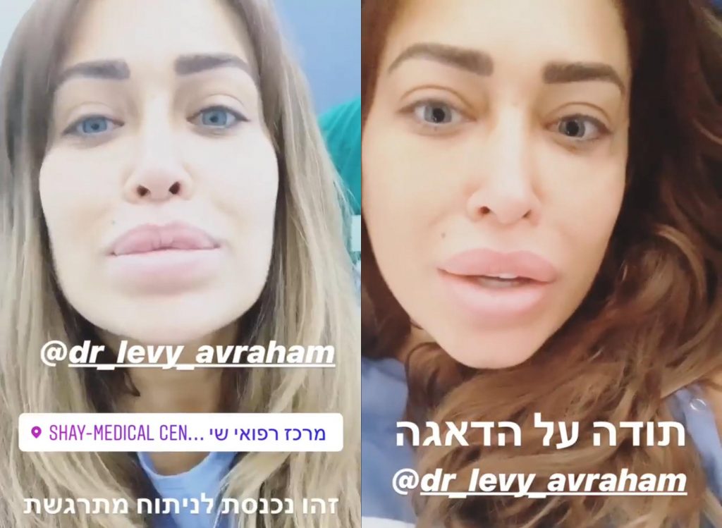 אביבית בר זוהר נכנסה לניתוח להסרת השתלים בישבן!