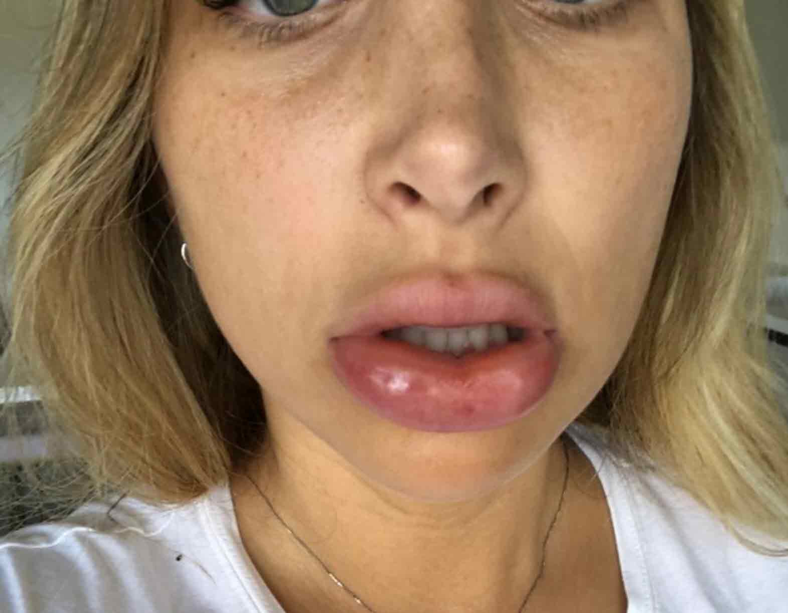 אוי לא: מה קרה לשפתיים של מעיין אשכנזי!?