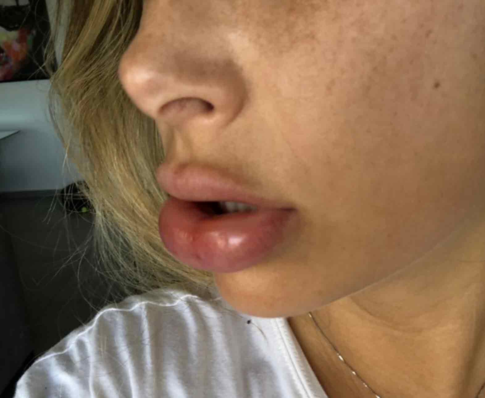 אוי לא: מה קרה לשפתיים של מעיין אשכנזי!?