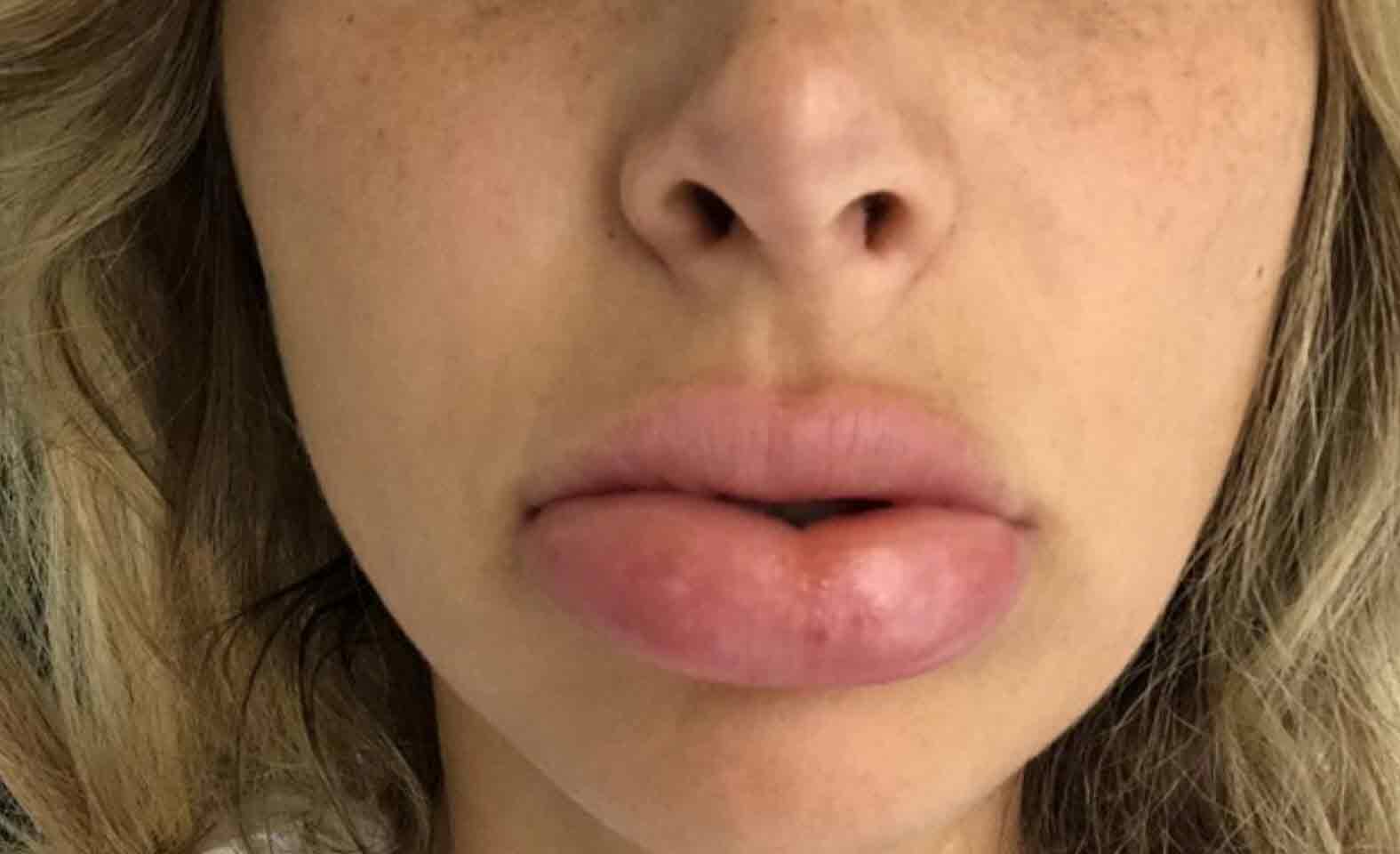 אוי לא: מה קרה לשפתיים של מעיין אשכנזי!?