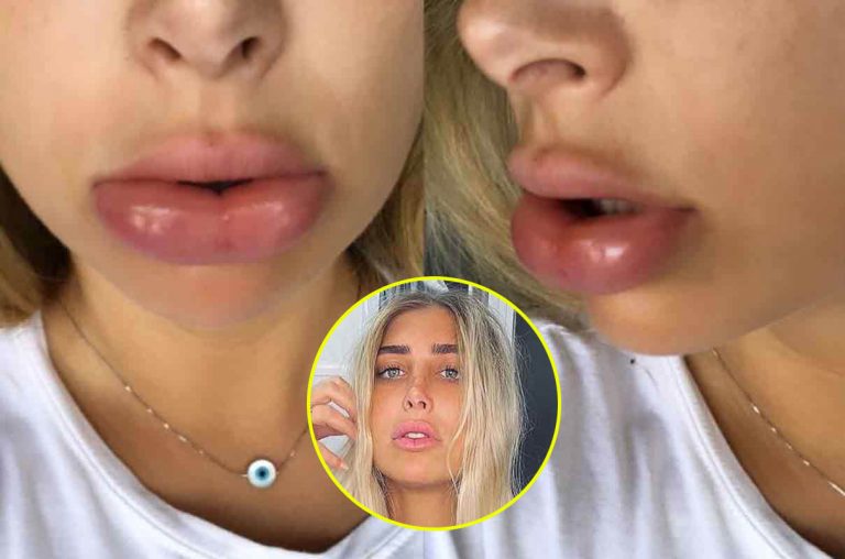 אוי לא: מה קרה לשפתיים של מעיין אשכנזי!?