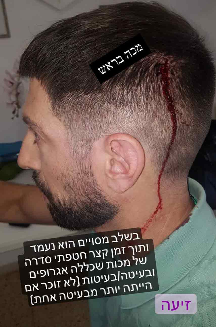 אחרי שנפגע במהלך הצילומים: חיים אתגר חושף את התוקף!