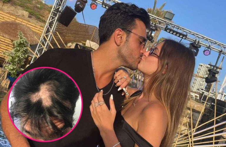 תום חיימוב שיתף באומץ על ההתקרחות הפתאומית:"בלאגן אחד גדול, תקופה נוראית"