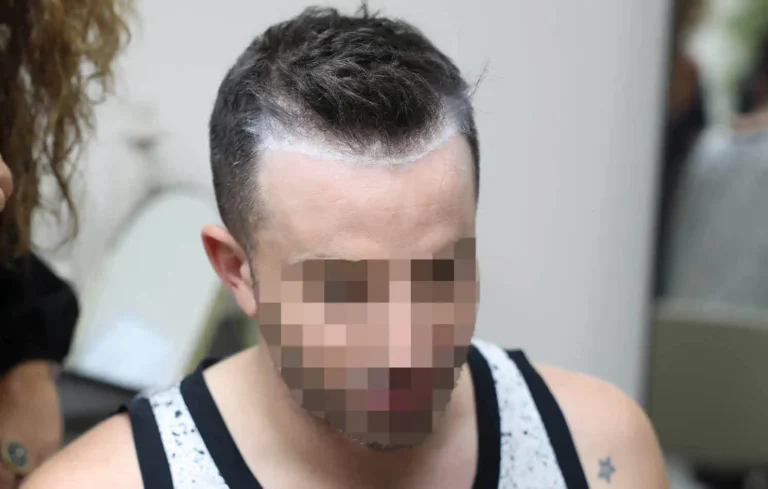 יוצא "האח הגדול" כבר לא מסתתר וחושף את השתלת השיער