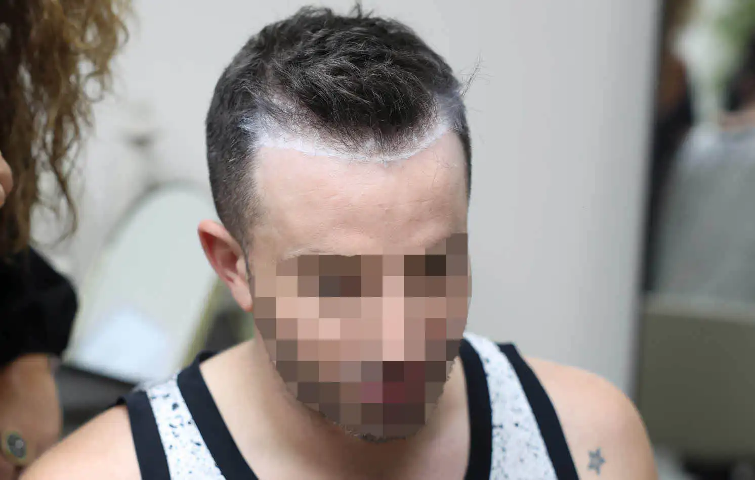 יוצא "האח הגדול" כבר לא מסתתר וחושף את השתלת השיער