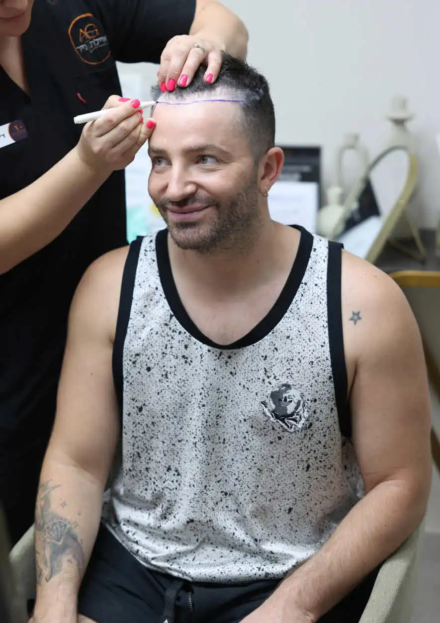 יוצא "האח הגדול" כבר לא מסתתר וחושף את השתלת השיער